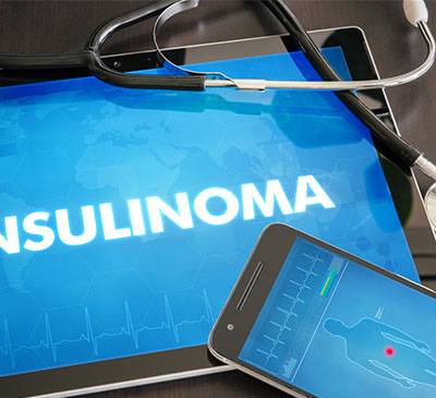Global Insulinoma Treatment Market 2019-2023